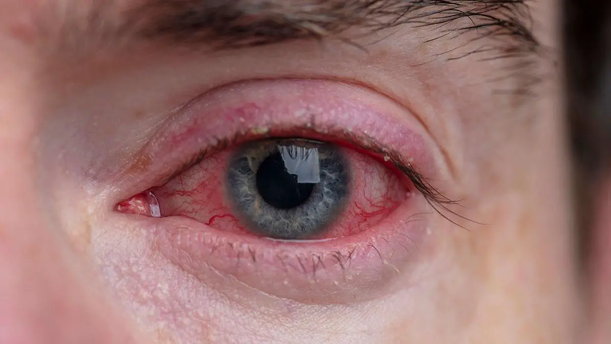 Conjunctivitis Demystified: Common Causes and Effective Home Remedies